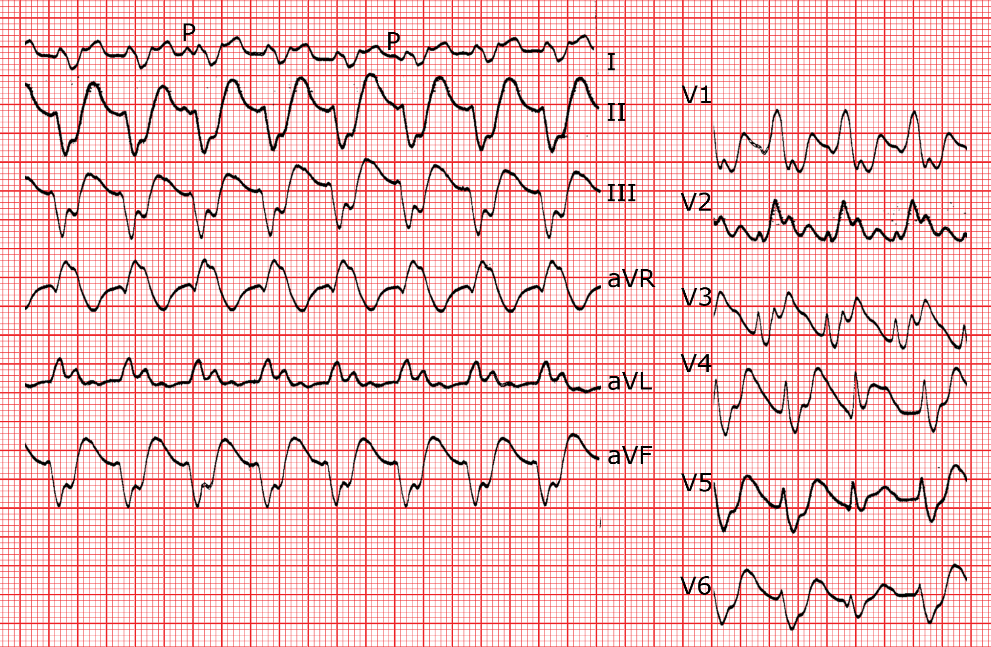 Les Tachycardies Ventriculaires TV ECG