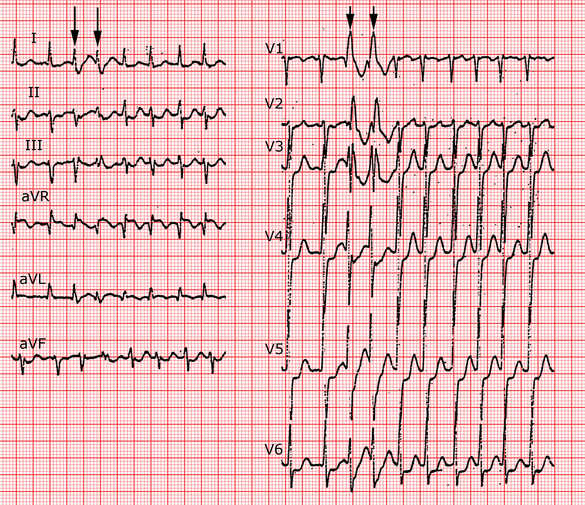 Die Supraventrikul ren Tachykardien ECG Die Supraventrikul ren Tachykardien ECG