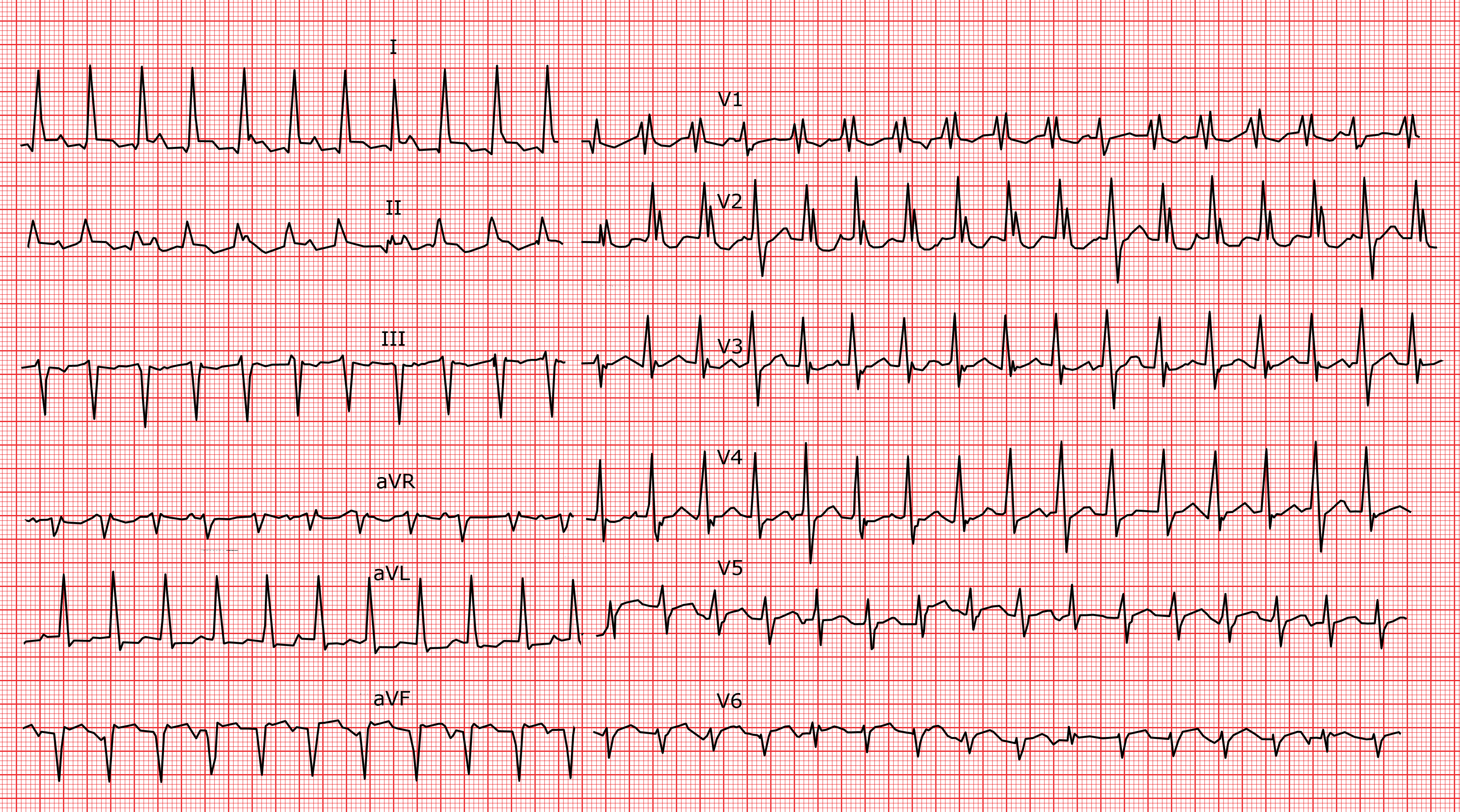 Les Tachycardies Ventriculaires TV ECG